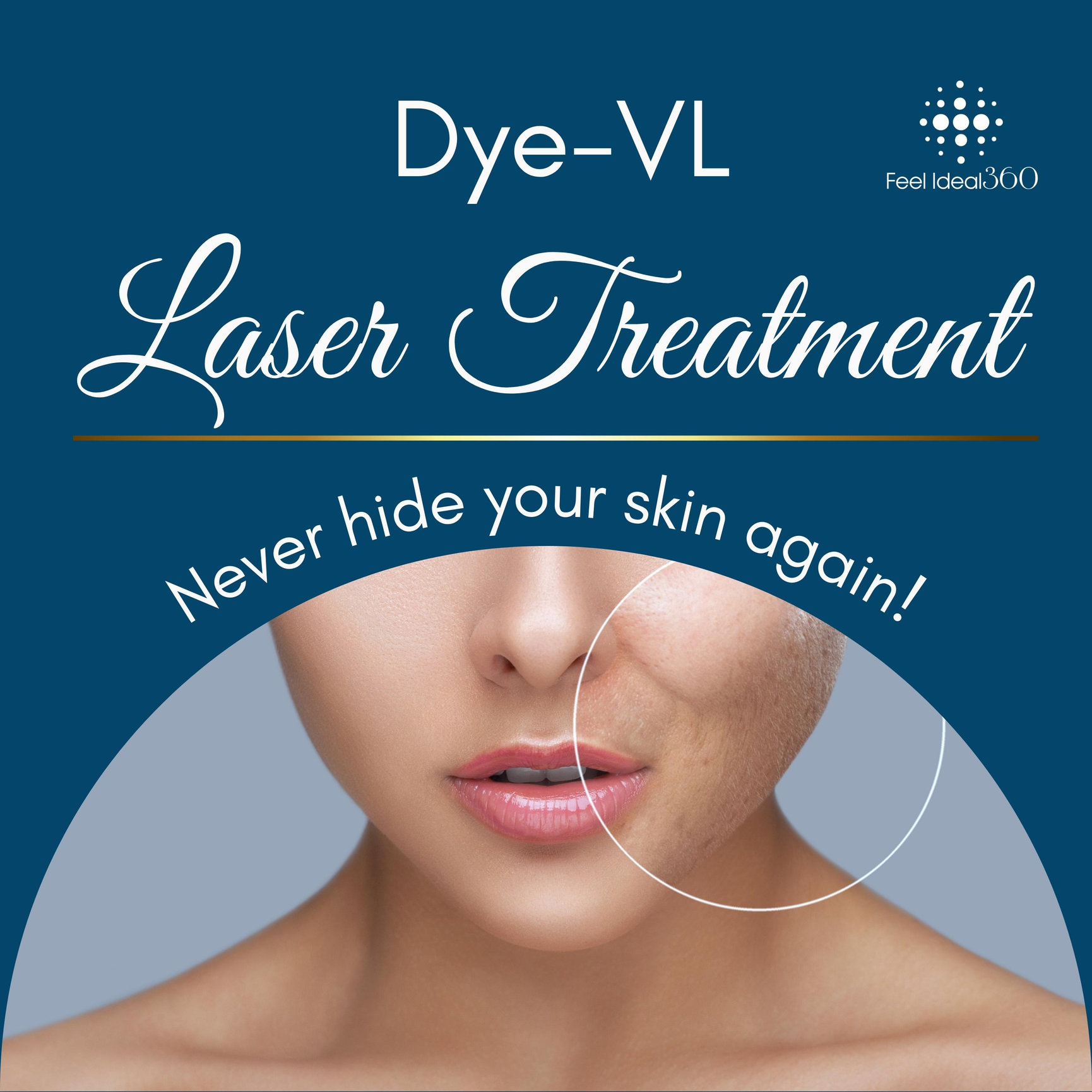 Pulsed Dye Laser Treatment Feel Ideal Med Spa Southlake Tx