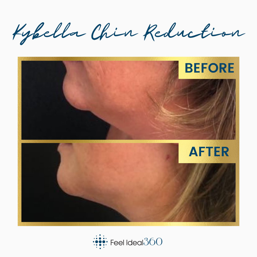 KYBELLA Double Chin Before And After Feel Ideal 360 Med Spa