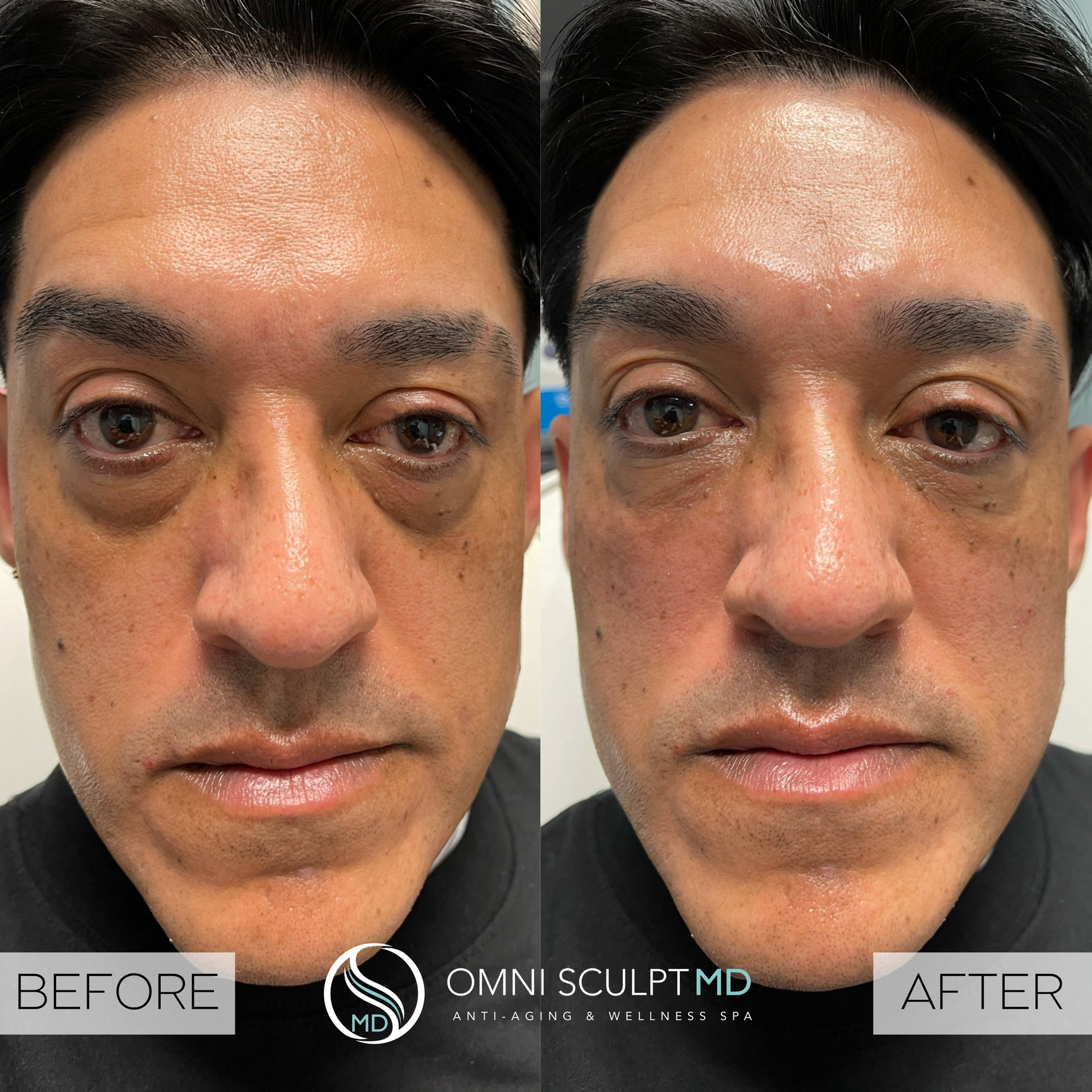 Facial Filler Before & After Gallery OMNI SCULPT MD