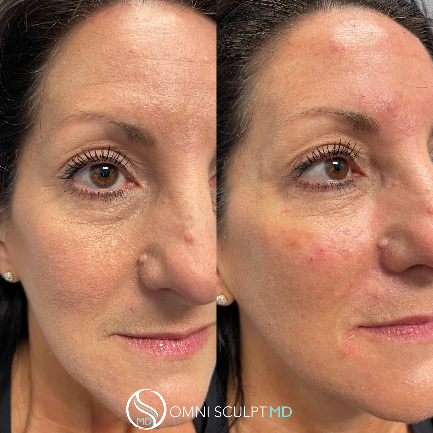 Under Eye Filler Before And After Gallery Omni Sculpt Md