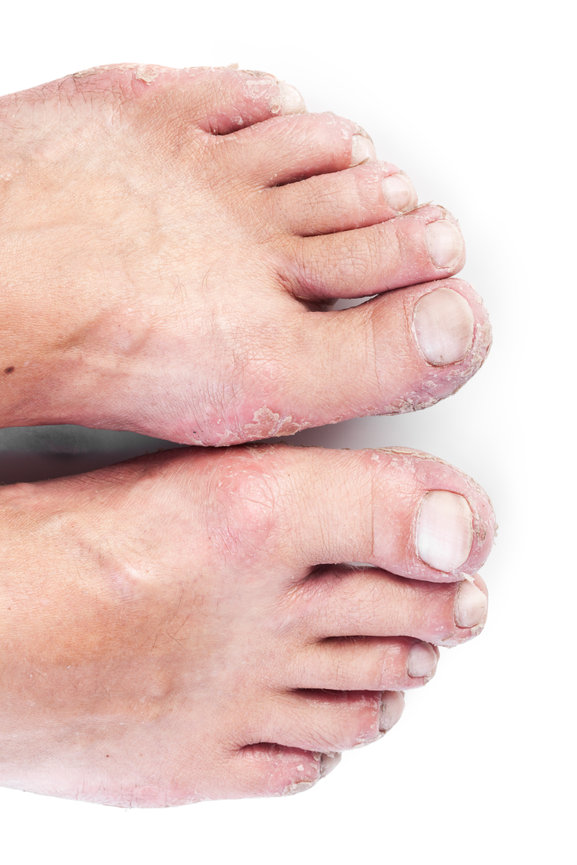 skin-rashes-foot-ankle-centers-of-frisco-and-plano