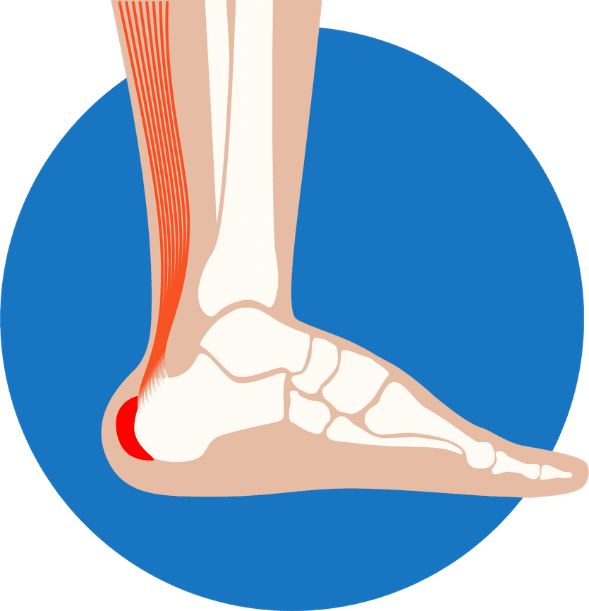 Bursitis - Foot & Ankle Centers of Frisco and Plano