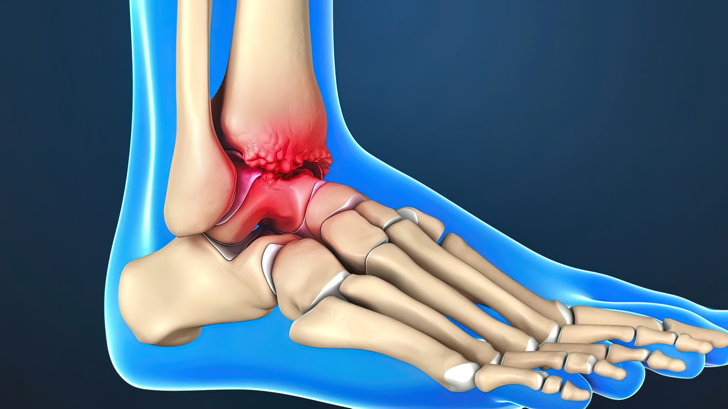 Ankle Arthritis Foot And Ankle Centers Of Frisco And Plano