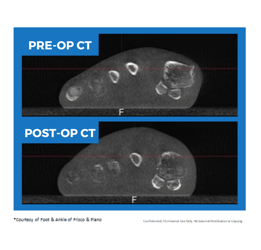 Lapiplasty Bunion Correction | Foot & Ankle Centers Of Frisco, Little ...