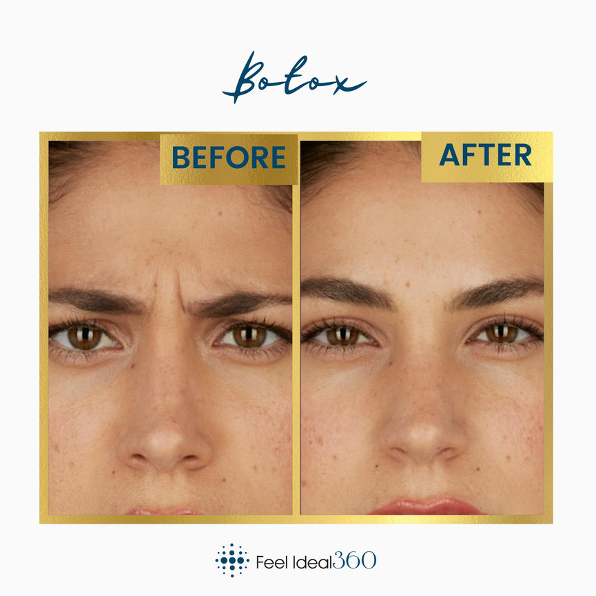 Botox Before And After Feel Ideal 360 Med Spa Southlake Tx