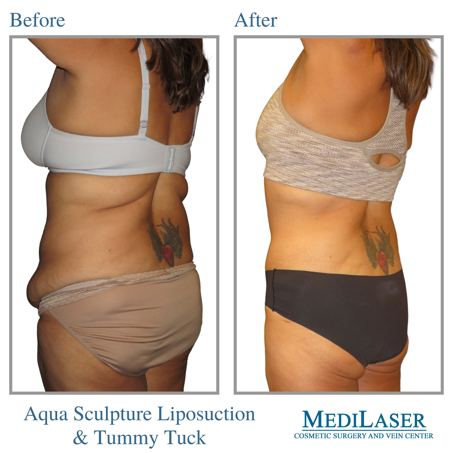 Tummy Tuck Liposuction Before and After - Medilaser Surgery and Vein Center