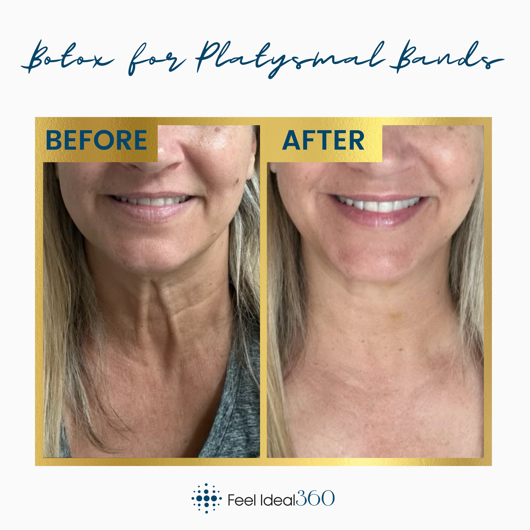 Before & After Botox Platysmal Bands Feel Ideal 360 In Southlake, Tx ...