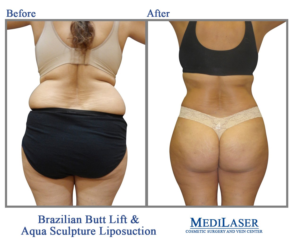 Galería - Advanced Liposuction Center