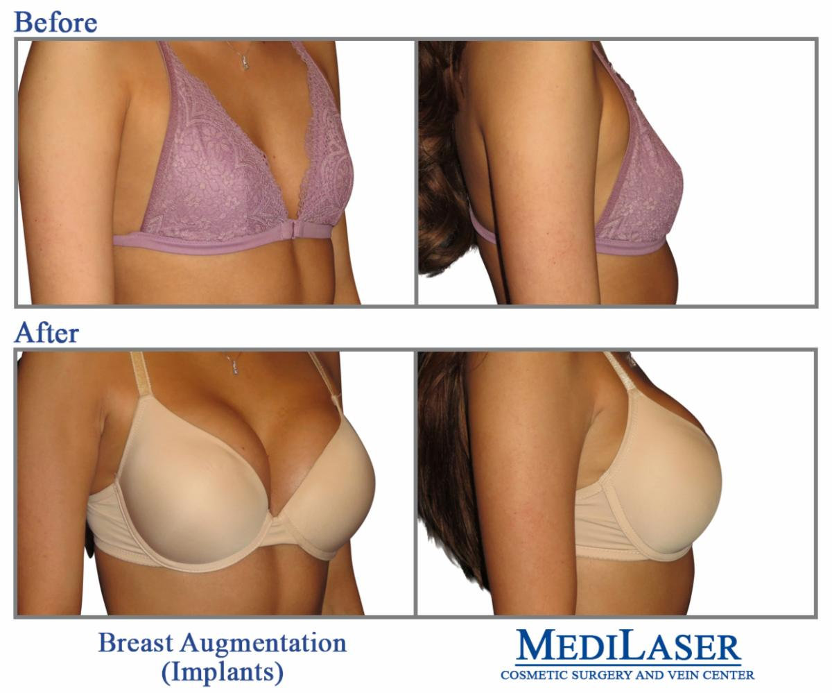 Before and After Breast Augmentation - Medilaser Surgery and Vein Center