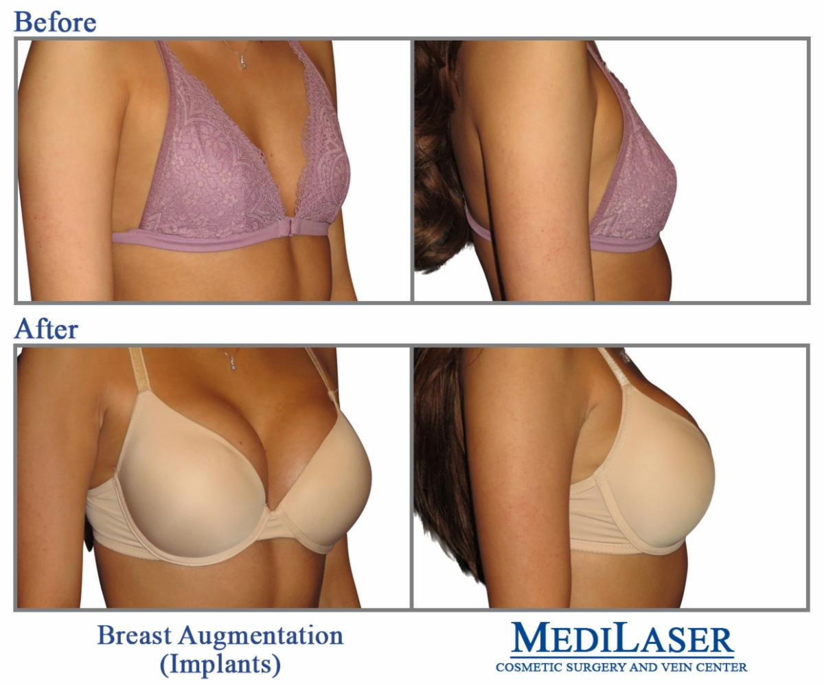 Breast Implants Pictures Before And After TBFK Breast Implants Pictures Before And After TBFK