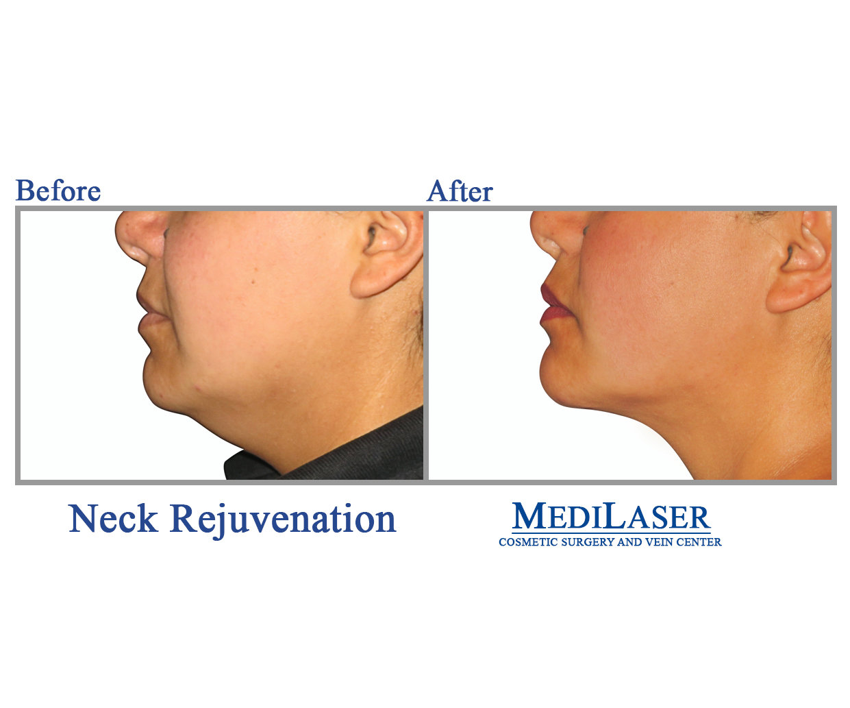 NECK REJUVENATION LIFT LIPO LIPOSUCTION RENUVION SKIN TIGHTENING